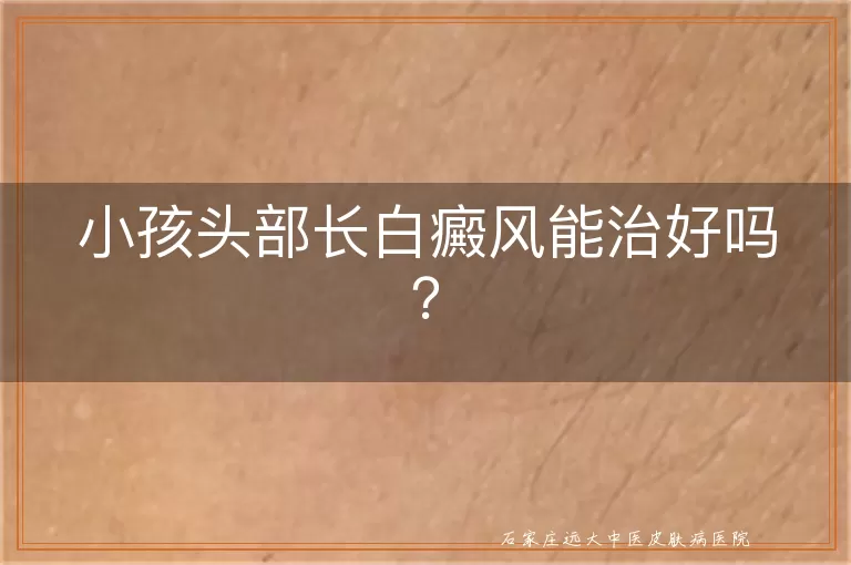 小孩头部长白癜风能治好吗？