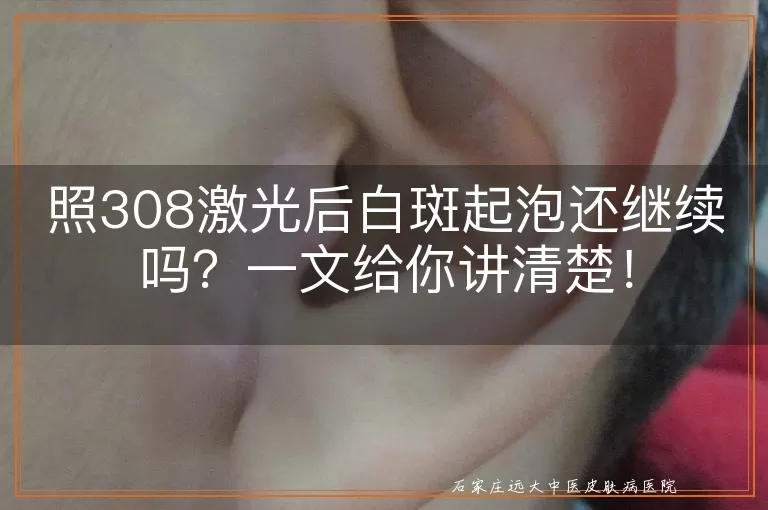 照308激光后白斑起泡还继续吗？一文给你讲清楚！