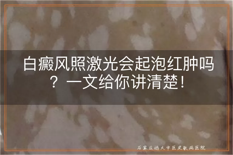 白癜风照激光会起泡红肿吗？一文给你讲清楚！