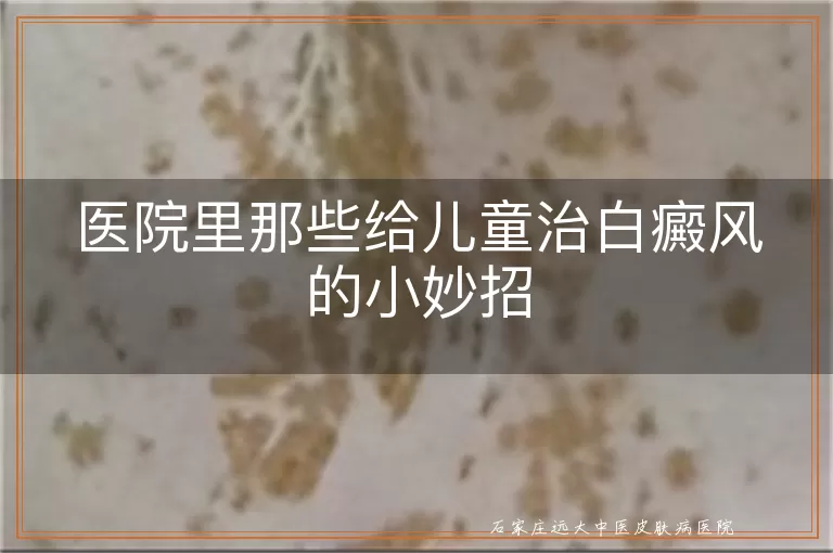 医院里那些给儿童治白癜风的小妙招