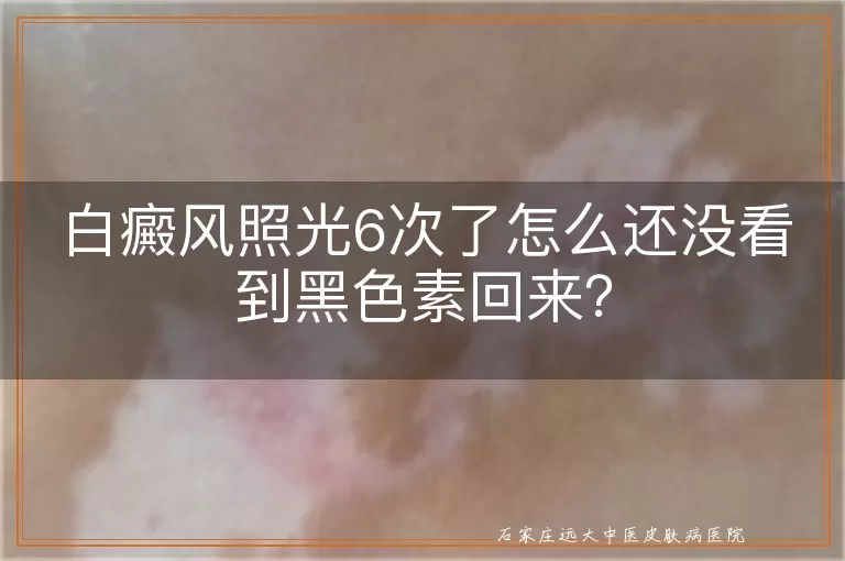 白癜风照光6次了怎么还没看到黑色素回来？