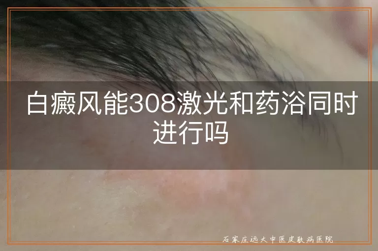 白癜风能308激光和药浴同时进行吗