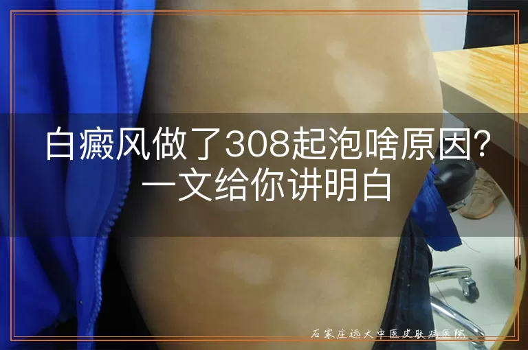 白癜风做了308起泡啥原因?一文给你讲明白