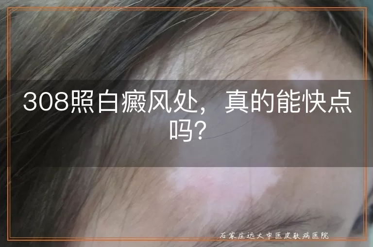 308照白癜风处，真的能快点吗？