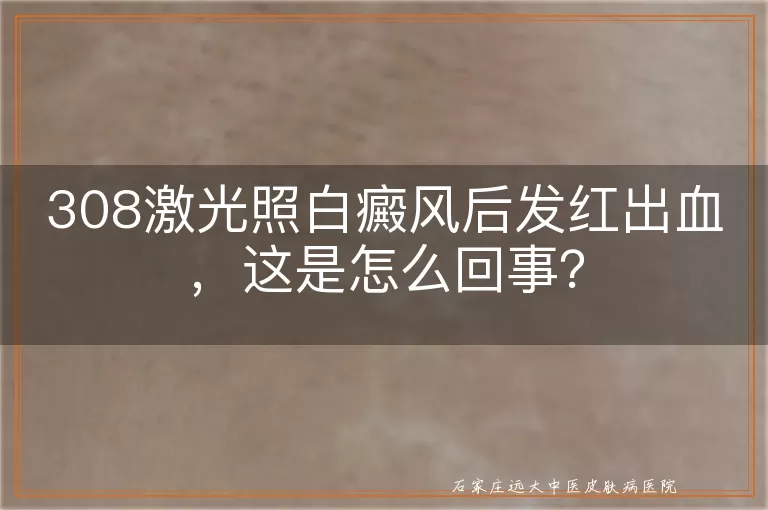 308激光照白癜风后发红出血，这是怎么回事？
