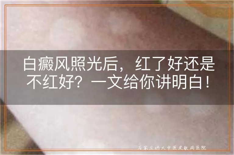 白癜风照光后，红了好还是不红好？一文给你讲明白！