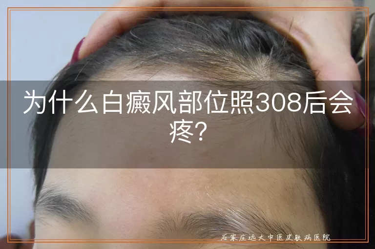 为什么白癜风部位照308后会疼？