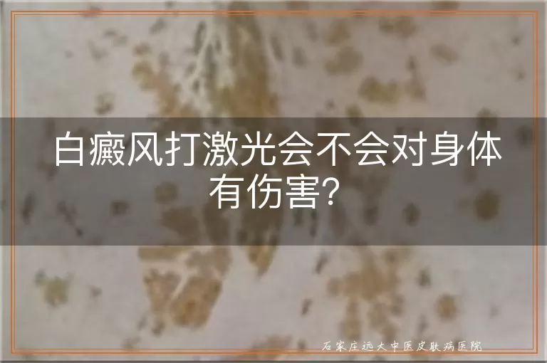 白癜风打激光会不会对身体有伤害？
