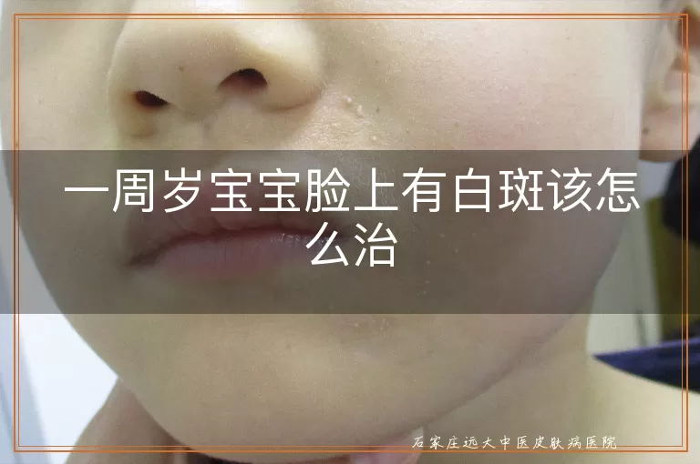 一周岁宝宝脸上有白斑该怎么治
