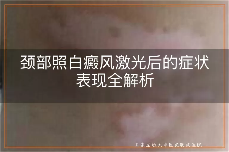 颈部照白癜风激光后的症状表现全解析