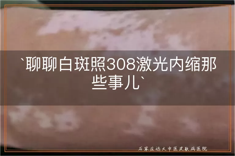 聊聊白斑照308激光内缩那些事儿