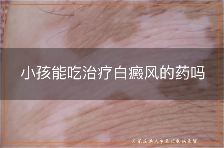 小孩能吃治疗白癜风的药吗