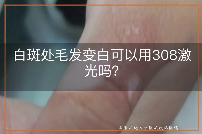 白斑处毛发变白可以用308激光吗？