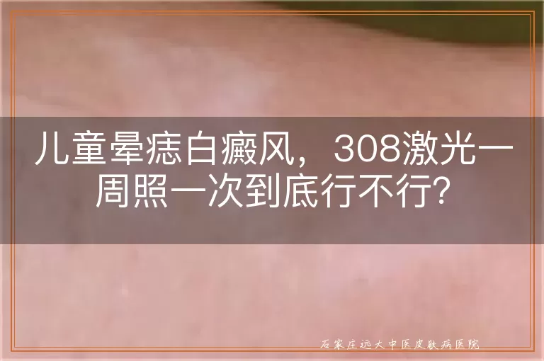 儿童晕痣白癜风，308激光一周照一次到底行不行？