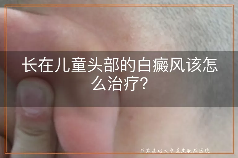 长在儿童头部的白癜风该怎么治疗？