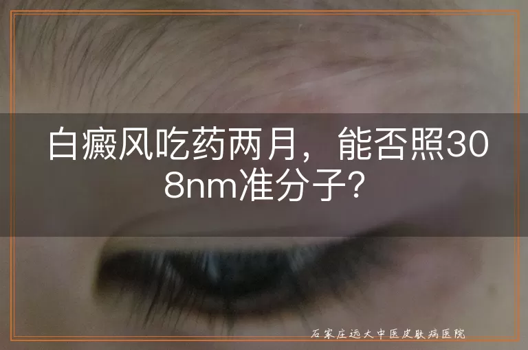 白癜风吃药两月，能否照308nm准分子？