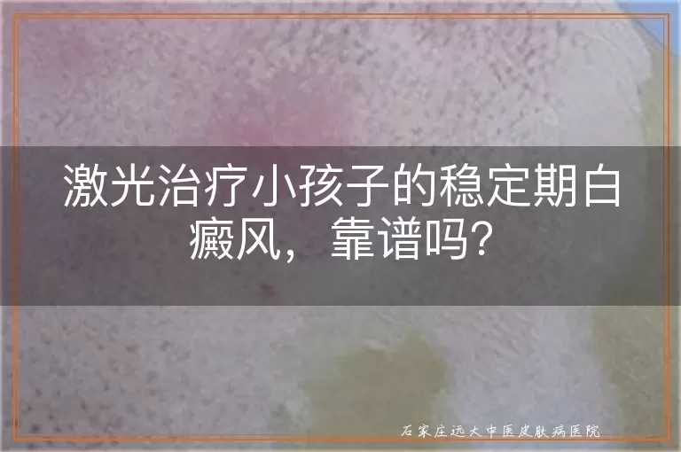 激光治疗小孩子的稳定期白癜风，靠谱吗？