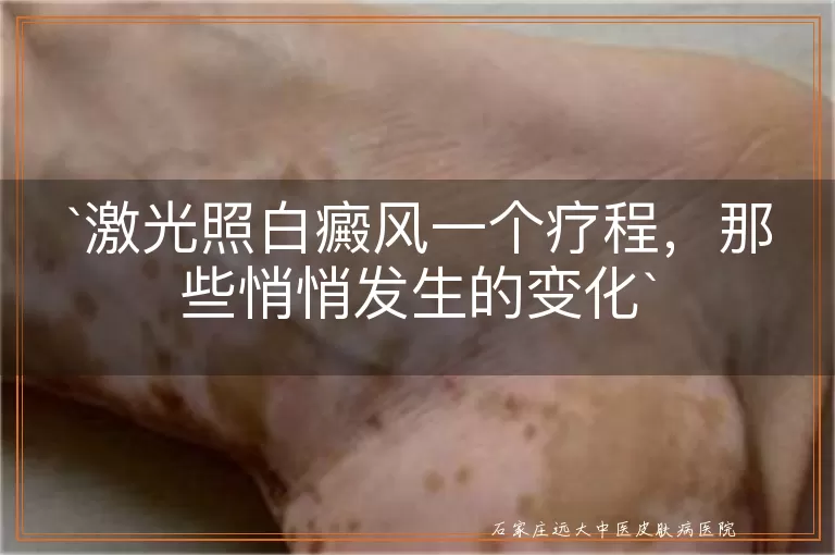激光照白癜风一个疗程，那些悄悄发生的变化