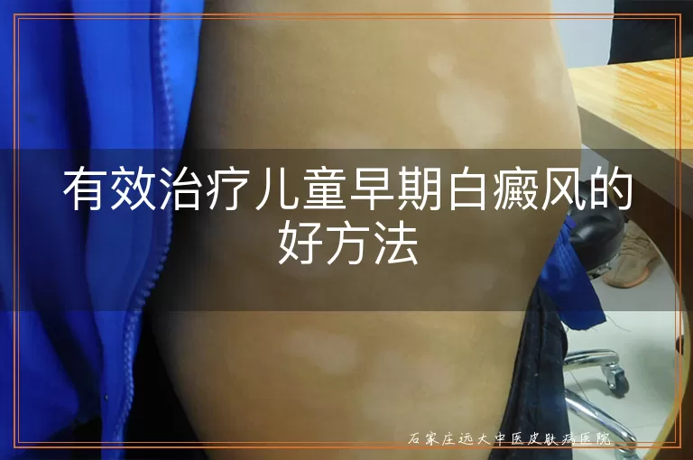 有效治疗儿童早期白癜风的好方法