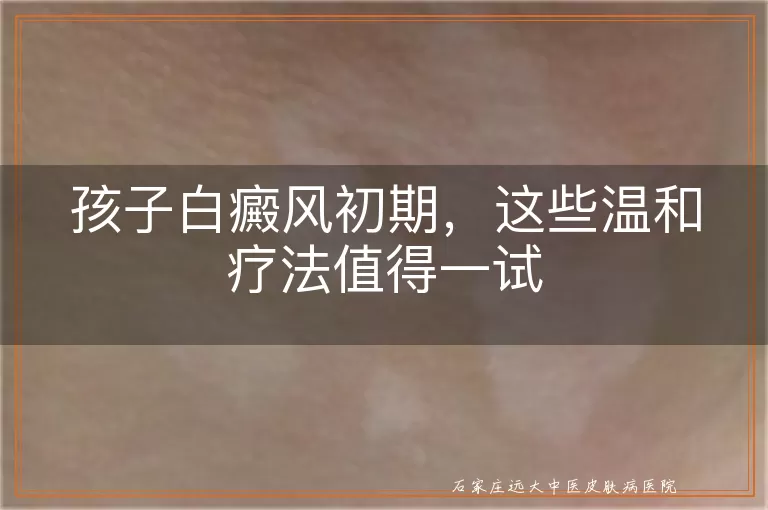 孩子白癜风初期，这些温和疗法值得一试