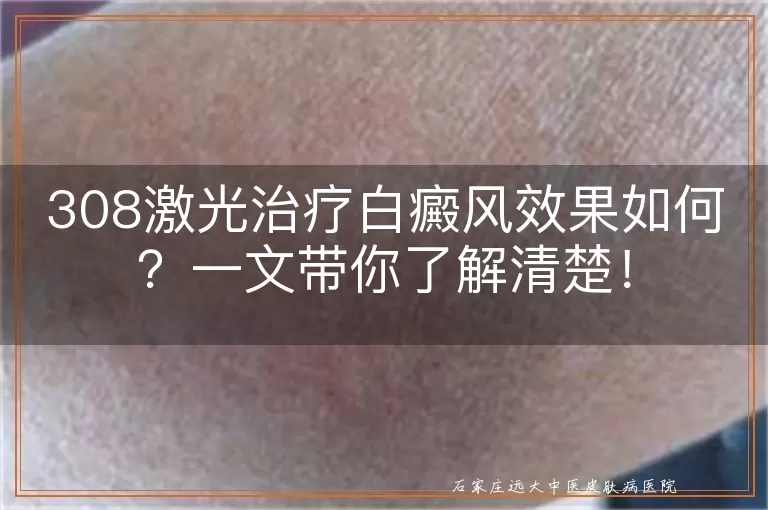 308激光治疗白癜风效果如何？一文带你了解清楚！