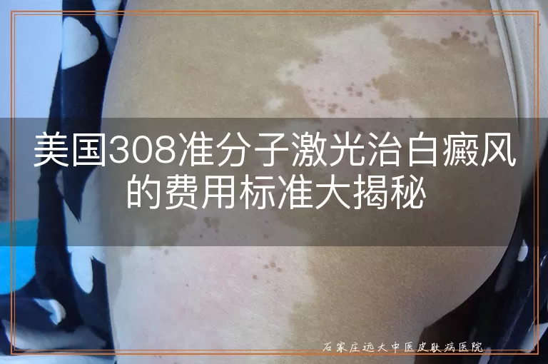 美国308准分子激光治白癜风的费用标准大揭秘