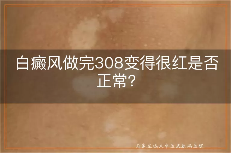 白癜风做完308变得很红是否正常？