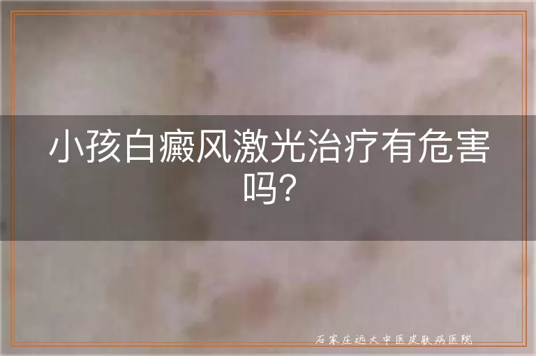 小孩白癜风激光治疗有危害吗？