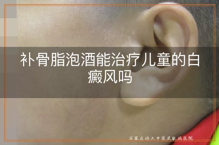 补骨脂泡酒能治疗儿童的白癜风吗