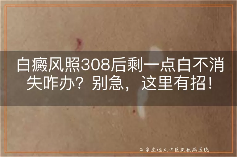 白癜风照308后剩一点白不消失咋办？别急，这里有招！