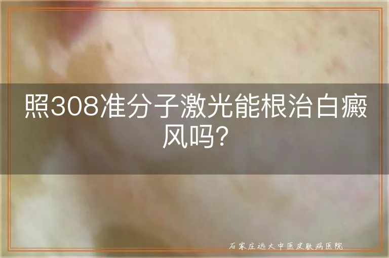 照308准分子激光能根治白癜风吗？