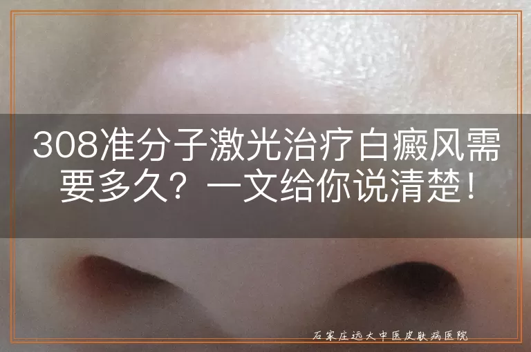 308准分子激光治疗白癜风需要多久？一文给你说清楚！