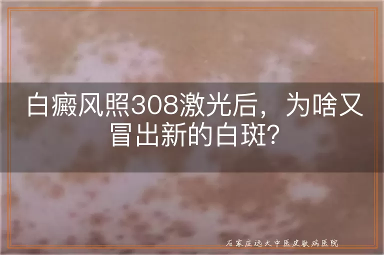 白癜风照308激光后，为啥又冒出新的白斑？