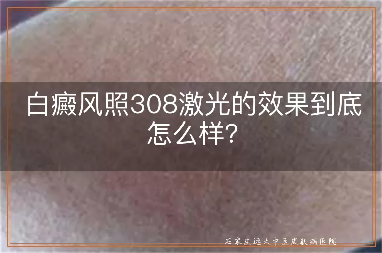 白癜风照308激光的效果到底怎么样？
