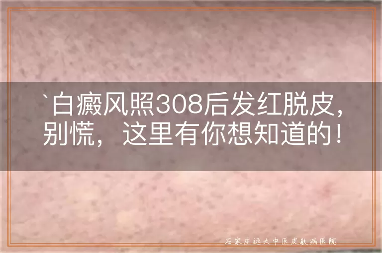 白癜风照308后发红脱皮，别慌，这里有你想知道的！