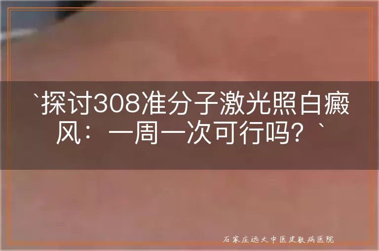 探讨308准分子激光照白癜风:一周一次可行吗?
