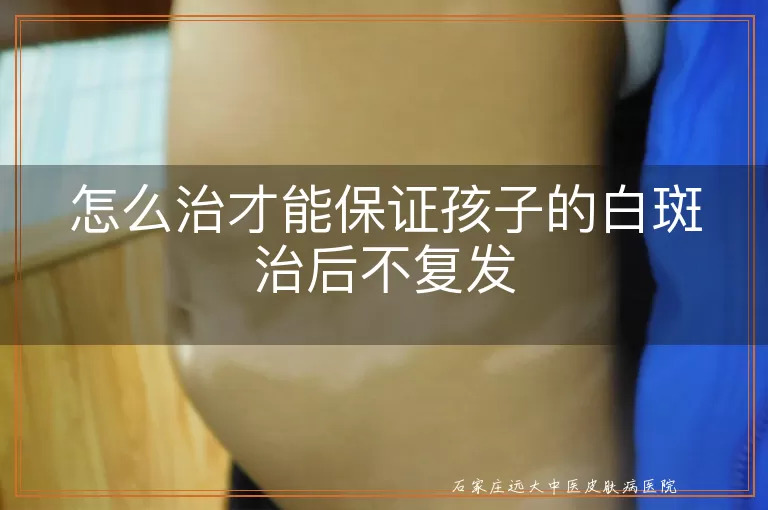 怎么治才能保证孩子的白斑治后不复发