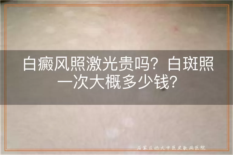 白癜风照激光贵吗？白斑照一次大概多少钱？