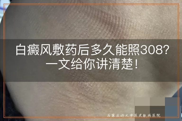白癜风敷药后多久能照308？一文给你讲清楚！
