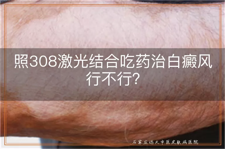 照308激光结合吃药治白癜风行不行？