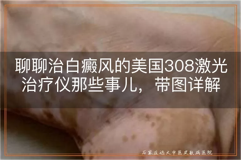 聊聊治白癜风的美国308激光治疗仪那些事儿，带图详解！