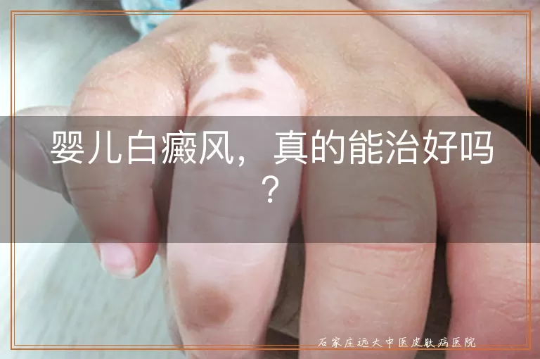 婴儿白癜风，真的能治好吗？