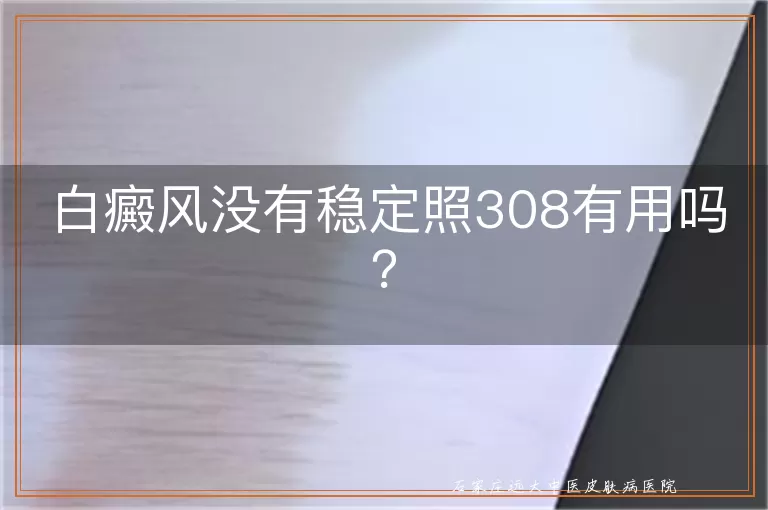 白癜风没有稳定照308有用吗?
