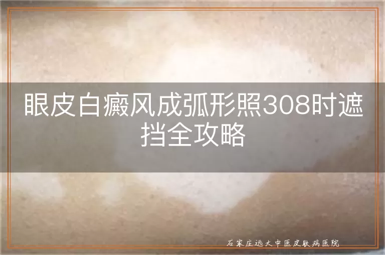 眼皮白癜风成弧形照308时遮挡全攻略