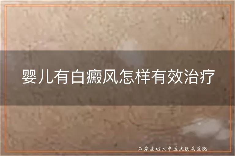 婴儿有白癜风怎样有效治疗