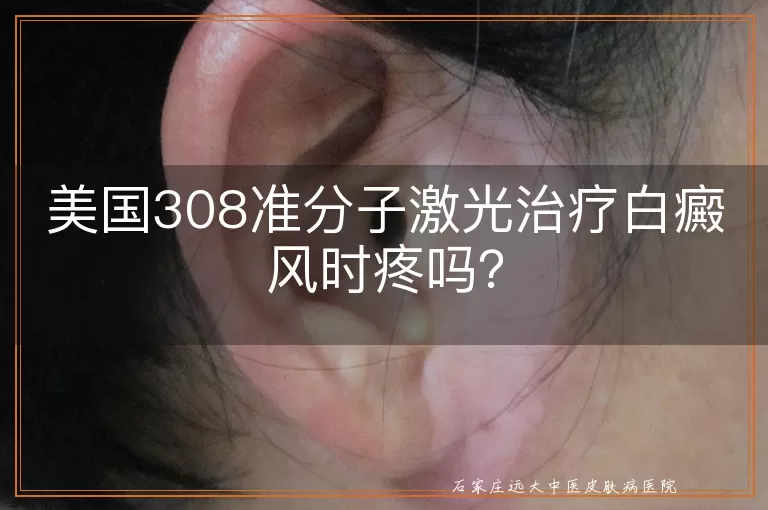 美国308准分子激光治疗白癜风时疼吗？
