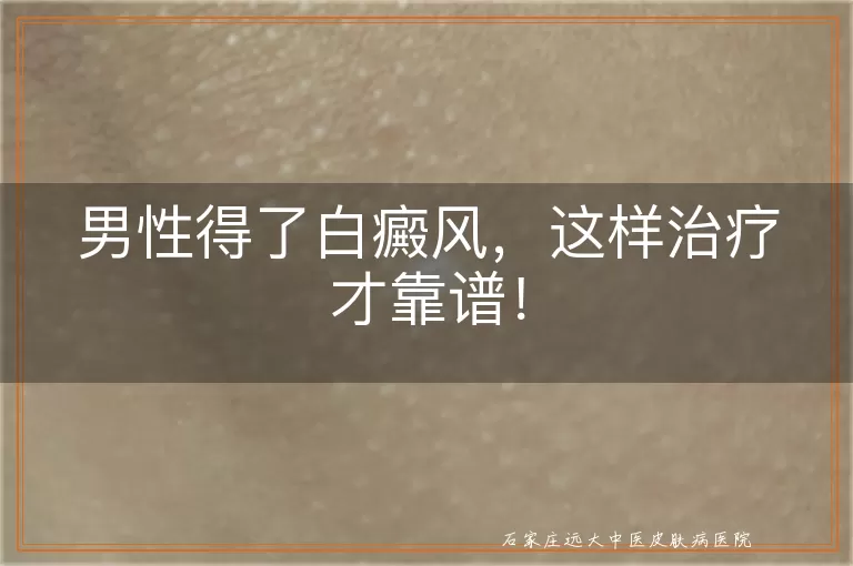 男性得了白癜风，这样治疗才靠谱！