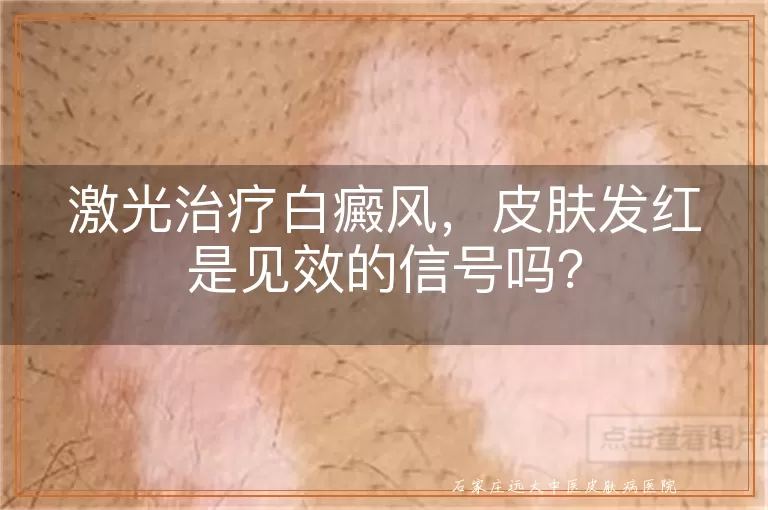 激光治疗白癜风，皮肤发红是见效的信号吗？