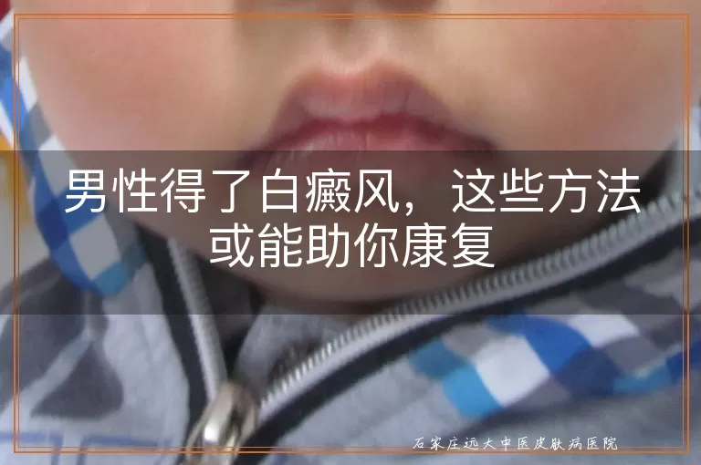 男性得了白癜风，这些方法或能助你康复