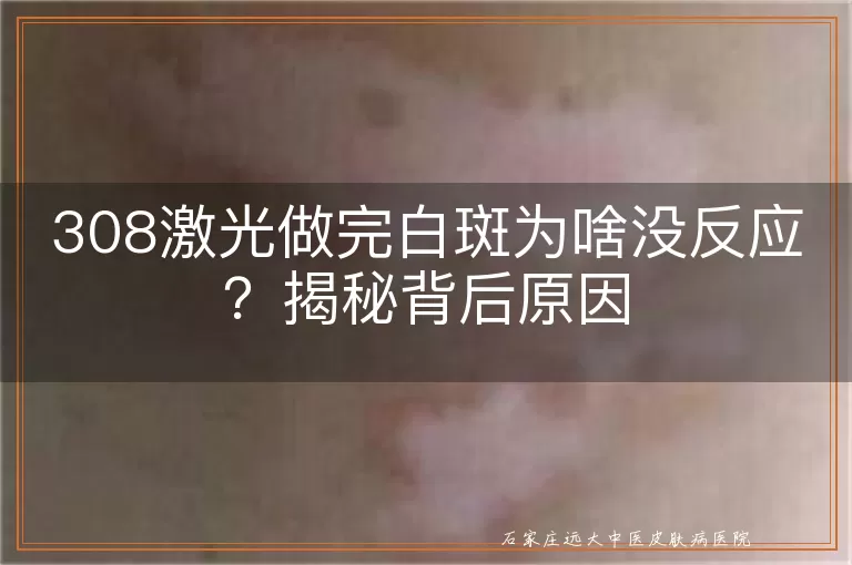 308激光做完白斑为啥没反应？揭秘背后原因